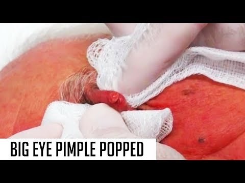 Big Eye Whitehead! PIMPLE POPPING 101