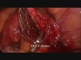Laparoscopic Surgery for Endometrioma • Video • MEDtube.net