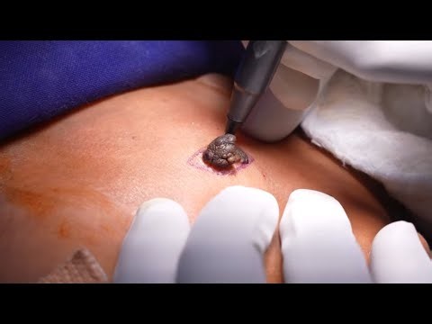 Large Mole Removed from Face