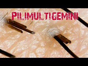 Pilimultigemini|Hair Extraction|multiple hairs|
