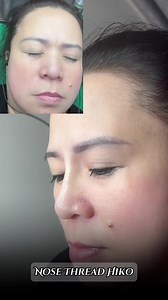 NOSE THREAD HIKO Customer make Nose Thread Hiko Welcome to Hana Beauty AbuDhabi Discount up 50% all services : Microshading Eyebrow - Lipsarding Collagen - Eyeliner Spray - Eyelash Extensions - Nose Thread Hiko - Nose Filler - Lip Filler - Under Eye Filler - Chin Filler - Cheek Filler - Botox Remova Wrinkles - Botox Slim Jawline - Remove Double Chin 📆 Book an appointment now to experience at HANA BEAUTY —————— 🌟🌟—————— HANA BEAUTY ☎️ Hotline / whatsapp: ⁨⁨ 056 297 2399 ⏰ Open: 9h00 - 22h00 #m