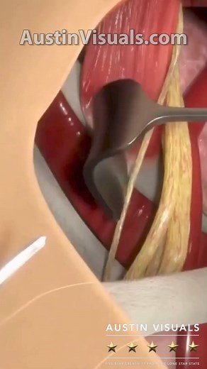 #3dmedicalanimation #austinvisuals #medicalanimation #medicalanimationstudio | Austin Visuals 3D Animation Studio | Facebook