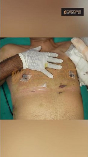 Gynecomastia Surgery Dressing
