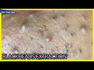 Big Cystic Acne Blackheads Extraction Blackheads & Milia | Sac Dep Spa #03