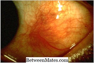 ההבדל בין סקריליטיס לאפיסקלריטיס | Scleritis לעומת Episcleritis - בריאות 2025
