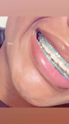 Teal Braces: Your Color Guide for a Fun Smile