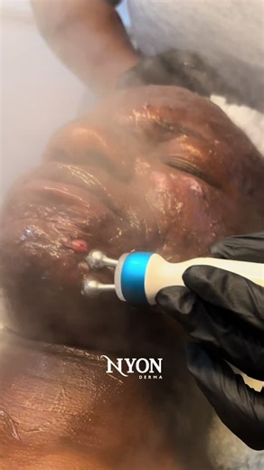 Nyon Derma: Lymphatic Drainage for Radiant Skin