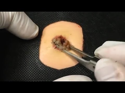 BEST Pimple Popping / Whiteheads Removal / Big Cystic Acne Blackheads / Squeezing Pimples / Tr#0039