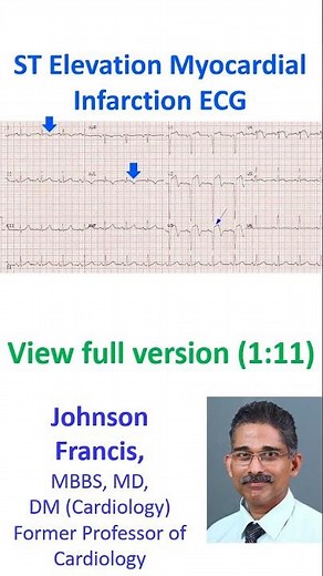 ST Elevation Myocardial Infarction ECG