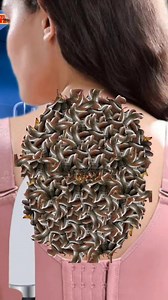 Treatment for severe maggot infestation on the backside #amar_asmr879 #asmrvideo | Asmr Sakir Medical