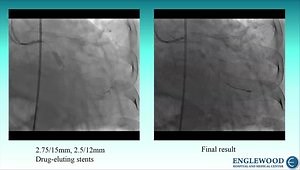 Excimer Laser Coronary Atherectomy