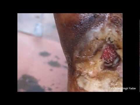 Maggots In Human Body- Therapy