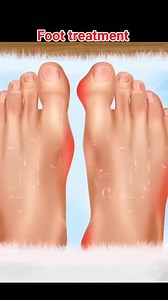 11K views · 36 reactions | Foot treatment & calluses removal for Athletes | #3danimation #StarsEverywhere #health #followers #tranding #animation | Akhilesh Yadav | Facebook