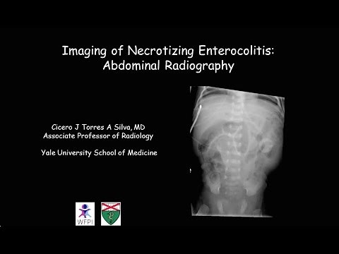 Necrotizing enterocolitis