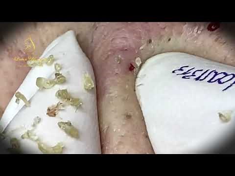 Best blackheads removal (313-1) | Loan Nguyen