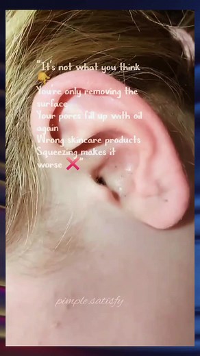 Why Blackheads Keep Coming Back: The Real Cause