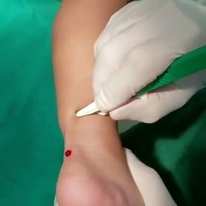 *TURN SOUND ON* Achilles tendon lengthening (ATL) is a surgical procedure that aims to stretch the Achilles tendon to allow a person to walk flat-footed without a bend in the knee, or to bring relief to chronic pain. This procedure elongates a contracted Achilles tendon by making small cuts on the tendons at the back of the ankle. Credit:Dr. Celso Rizzi | Dr.Weird