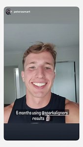 Spark Aligners on Reels