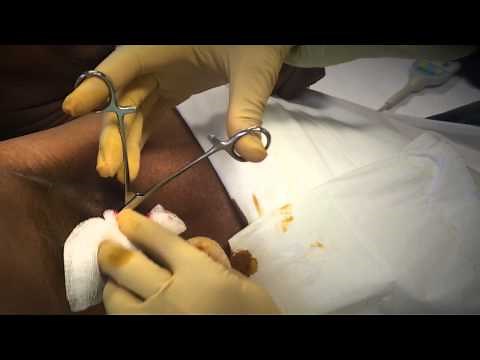 armpit abscess with retained gauze?