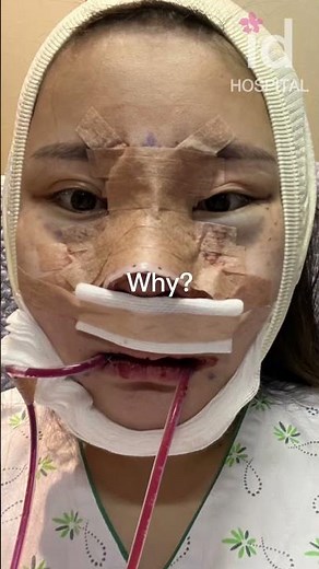 Plastic surgery transformation in Korea #idhospital #shorts