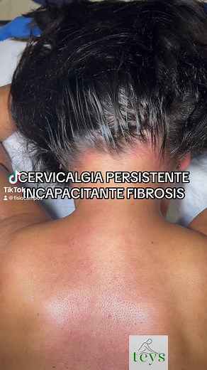 CERVICALGIA PERSISTENTE INCAPACITANTE, FIBROSIS. Paciente Incapacitada debidido al fuerte Dolor que padece 24/7 en el Cuello, lesiones antiguas que pasaron a Fibrosis y acumulacion de lesiones que le impedían hacer una vida normal. Localizamos y tratamos cada punto doloroso Eliminando el Dolor y Recuperando la Calidad de Vida 💯💚💎®️#teys #fisiocampos #cervicalgia #fibrosis #fisioterapeuta #fisioterapia | Francisco Campos Chica