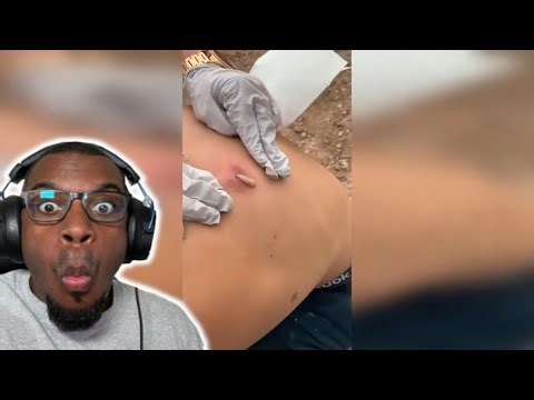 REACTING To The Best Cyst and Pimple Pop Compilation