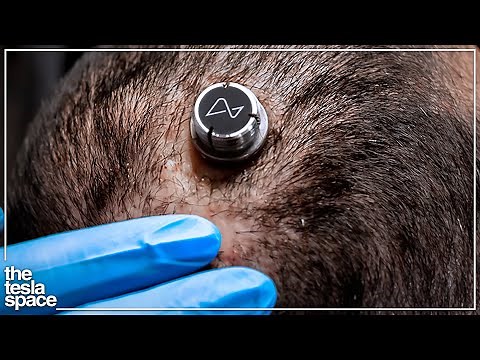 Neuralink Begins First Human Experiments!