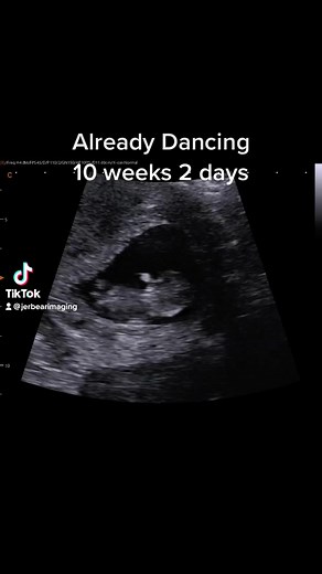 Get it baby!! 😁🥰 #jerbearimaging #dancingbaby #inhomeultrasound #10weeks2days #pregnant #brownwoodtx www.jerbearimaging.com | JerBear Imaging