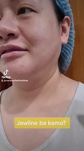 The perfect solution to sagging face and neck. The Rouralyft. Combination techniques of Microlipo of the face and neck, Fat grafting, Internal RF skin tightening with or without a lift. #HubogROURA #contouredbyroura #thefatsucker #Rouralyft | ROURA Aesthetic Institute