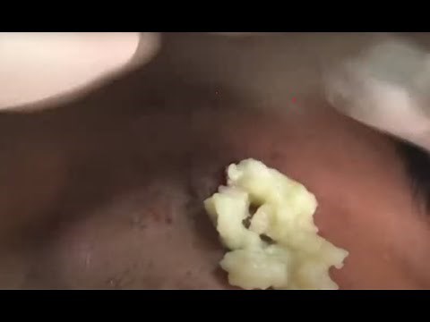 Crazy Satisfying cyst and Blackheads Remove 2024