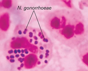 Neisseria gonorrhoeae: Disease, Pathogenesis, Lab Diagnosis | Microbe Online