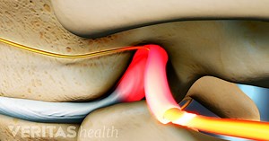How a Herniated Disc in Your Upper Back Causes Pain, Numbness, and Weakness