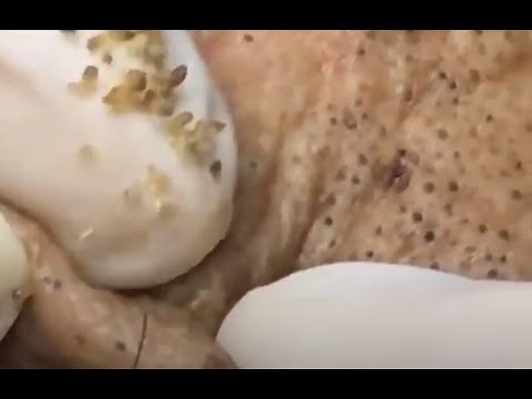 Cystic Acne 100 Years old man with many blackheads Acne Treatment