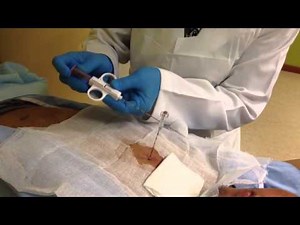 TRANS THORACIC CORE NEEDLE BIOPSY BY CHEST CT SCAN GUIDED