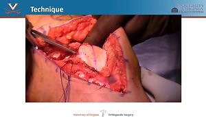 Innovative Technique: Trochleoplasty: When and How?