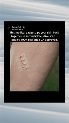 The End of Stitches? This Medical Gadget Zips Skin Together! 🤯#shorts #shortsfeed