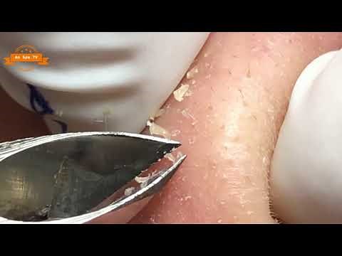 #02 Best Nose Plucking Blackheads Whiteheads Removal | Acne Treatment