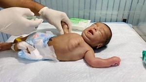 111K views · 2.2K reactions | Nephrotic Syndrome in Babies | Puffy Face & Swelling Explained #nephroticsyndrome #newbornbaby #BabyCare #trending #viral #shorts | Anoop Gautam | Facebook