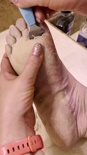 Effective Callus Removal Techniques for EPPK Patients