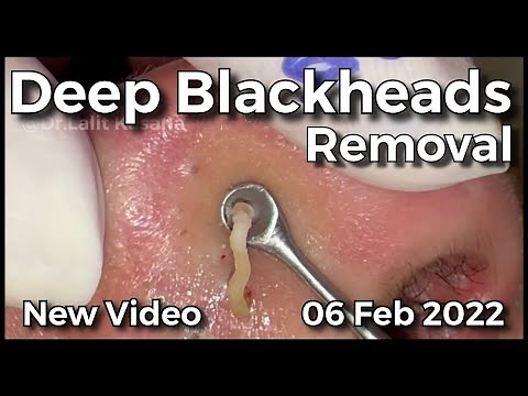 Deep Blackhead Removal by ‪@drkasanas‬