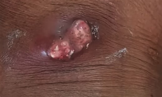 Big Infected Abscess on Back Drained