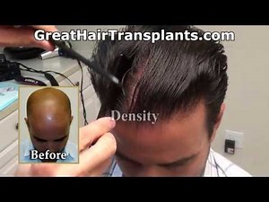 Dr. Brett Bolton Hair Transplant Results