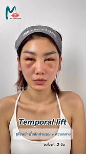 ดึงหน้าชั้นลึก (Temporl lift) Deep plane fcelift #ซ่อนแผลในผม...