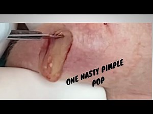 CYST ON NECK
