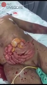 Woman Intestines Out Of The Stomach And Still Alive