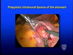 Prepyloric Intramural Lipoma of the Stomach - Laparoscopic Excision • Video • MEDtube.net