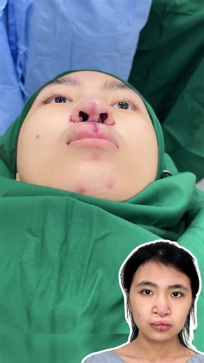 Cập nhật kết quả sau phẫu thuật sứt môi hở hàm ếch tại JKNH