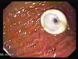 Percutaneous Endoscopic Gastrostomy - PEG (4 of 6) • Video • MEDtube.net