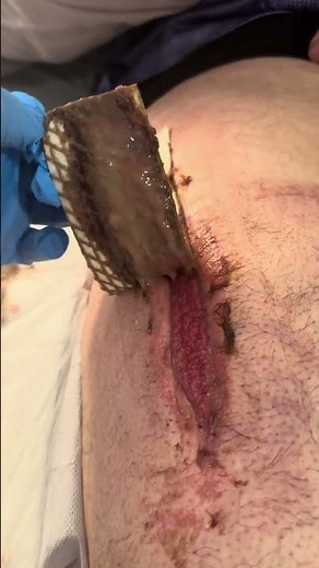 See the effect of UrgoClean Ag at removal