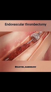 108K views · 361 reactions | Great post from @master_cardiology...